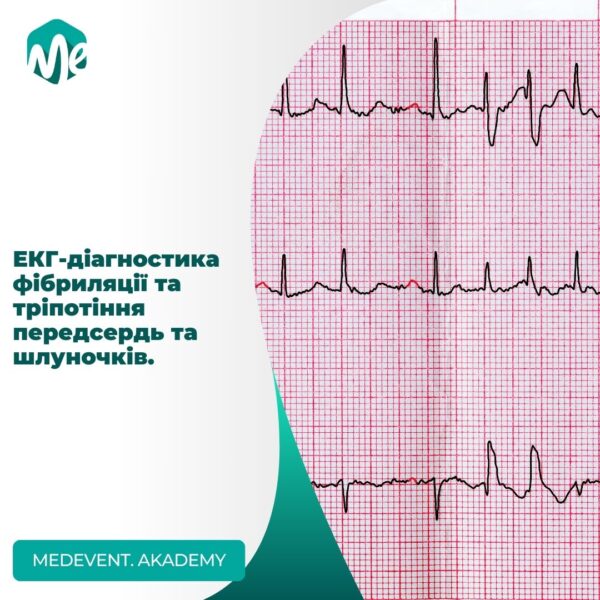 Екг-діагностика фібриляції та тріпотіння передсердь та шлуночків.