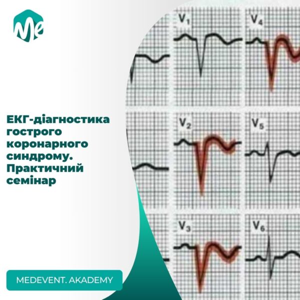 Екг діагностика гострого коронарного синдрому