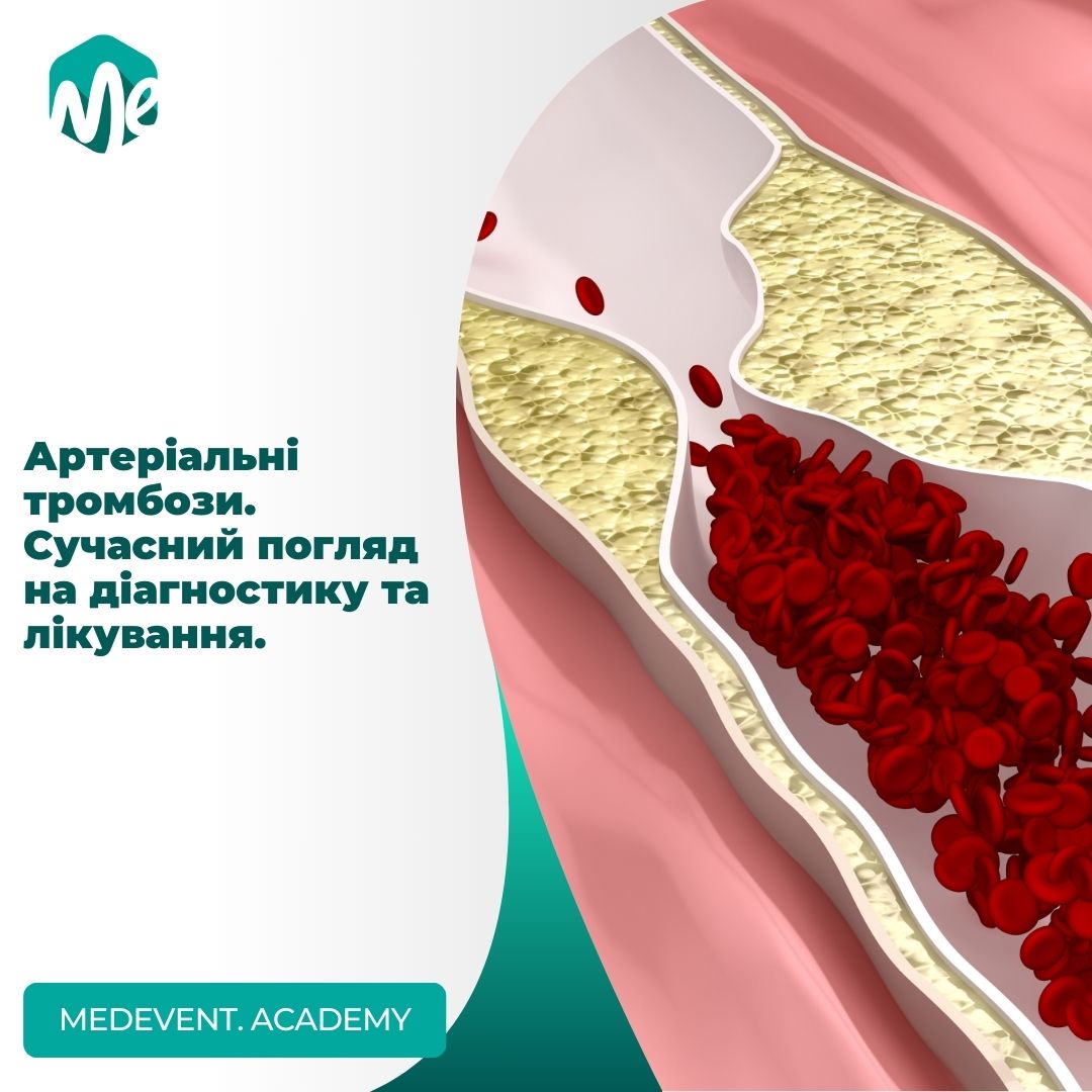 Артеріальні тромбози. Сучасний погляд на діагностику та лікування.