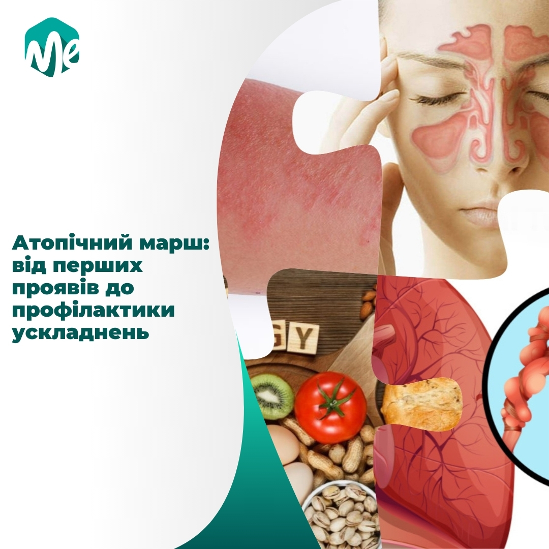 Атопічний марш: від перших проявів до профілактики ускладнень