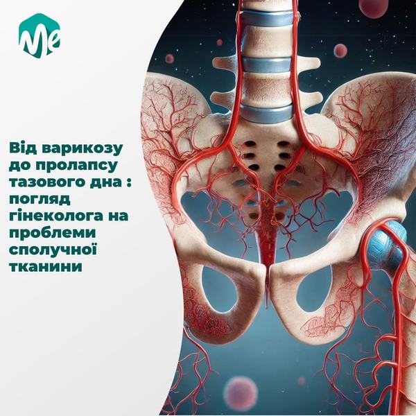 Від варикозу до пролапсу тазового дна : погляд гінеколога на проблеми сполучної тканини